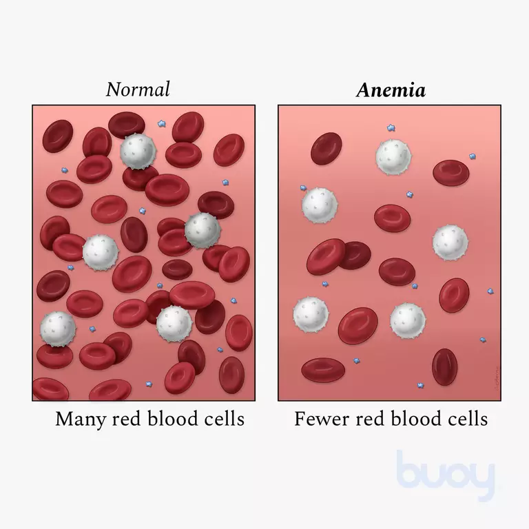 Anemia blood, Normal blood.